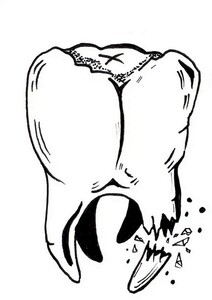 illustration dent